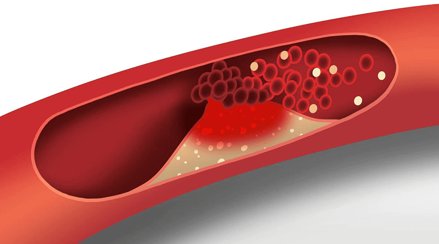 cholesterol
