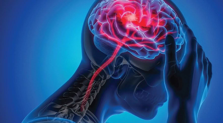 ischemic stroke