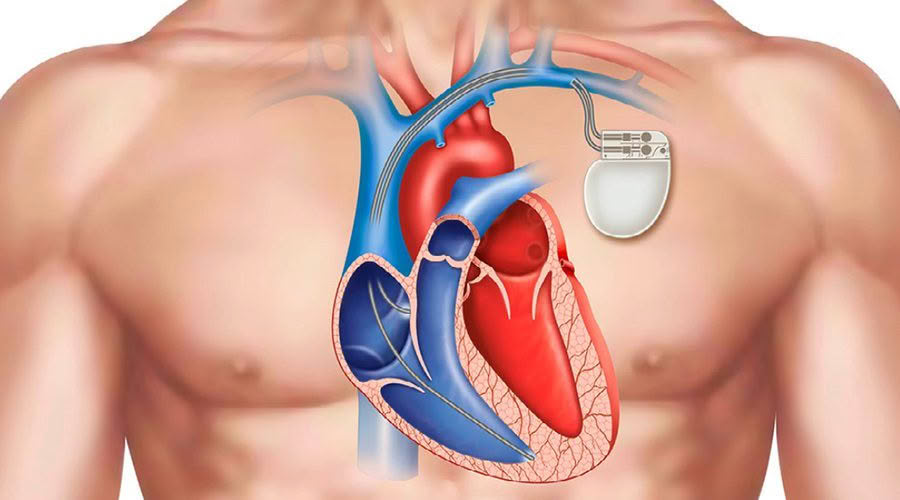 pacemaker
