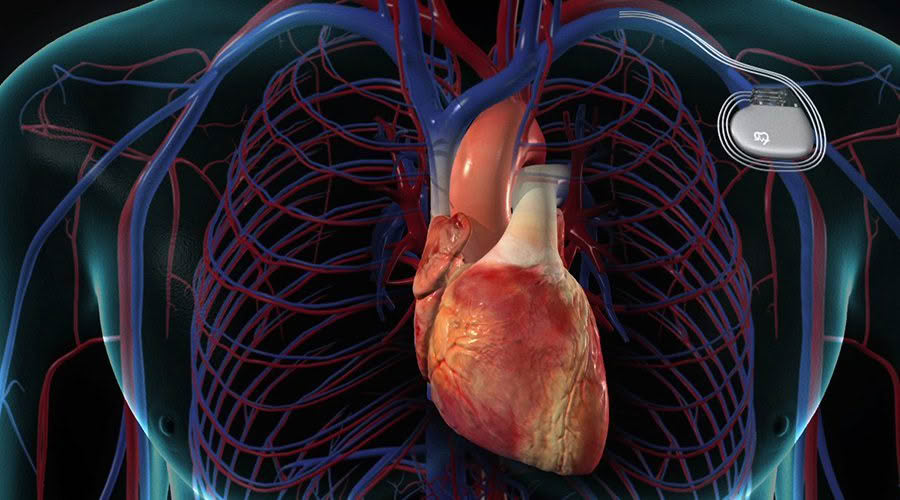 pacemaker