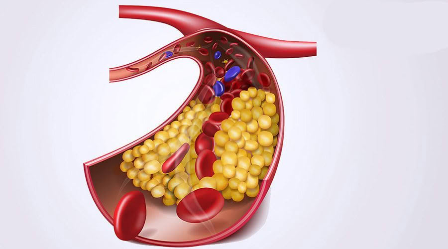 hyperlipidemia