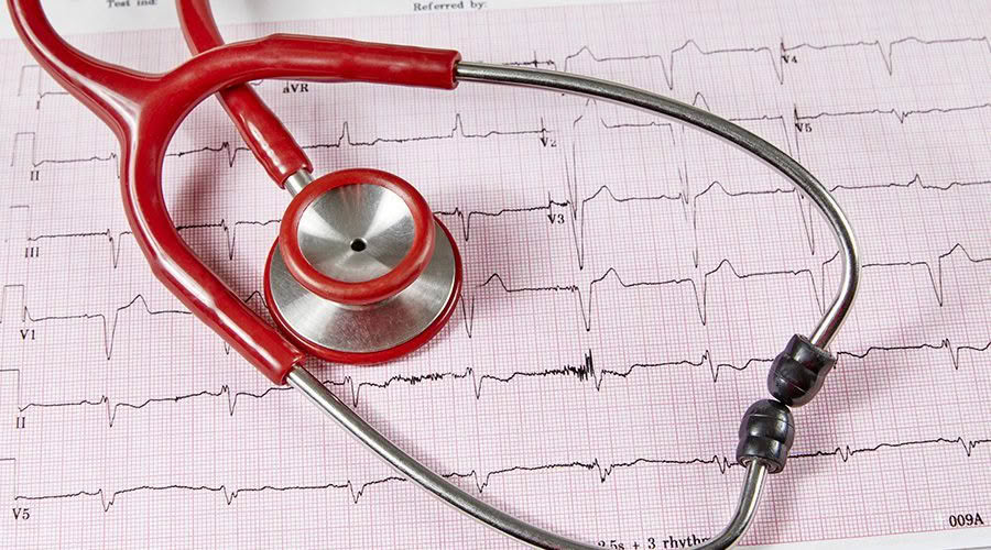 atrial fibrillation ecg