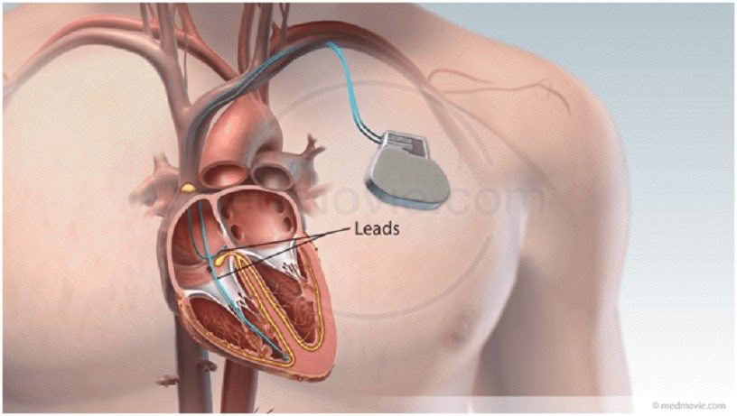 pacemaker implantation